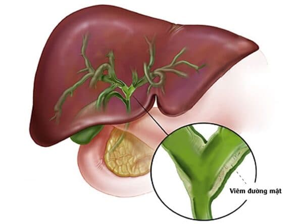 Triệu chứng viêm túi mật
