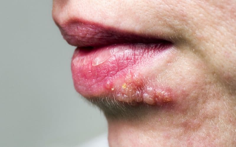Herpes là một trong các bệnh qua đường tình dục khó có thể chữa khỏi