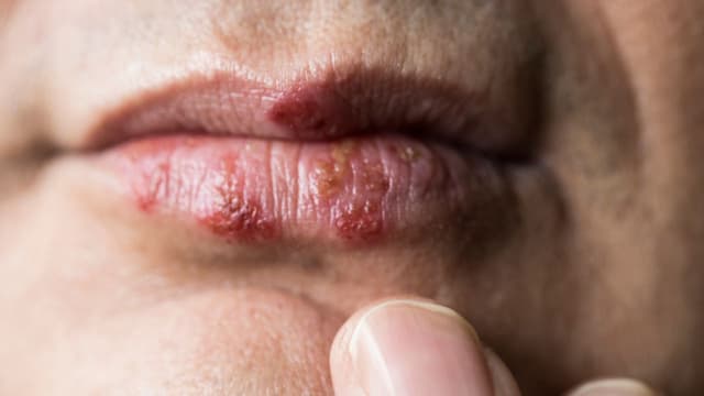 Tìm hiểu về bệnh Herpes lây qua đường tình dục