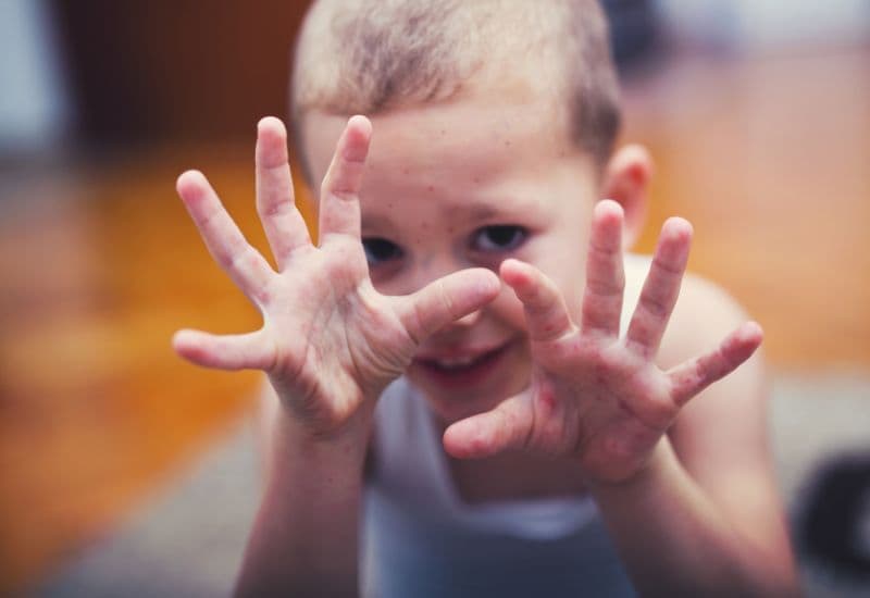 Giải đáp chi tiết thắc mắc: Bệnh chân tay miệng ở trẻ em cần kiêng gì?