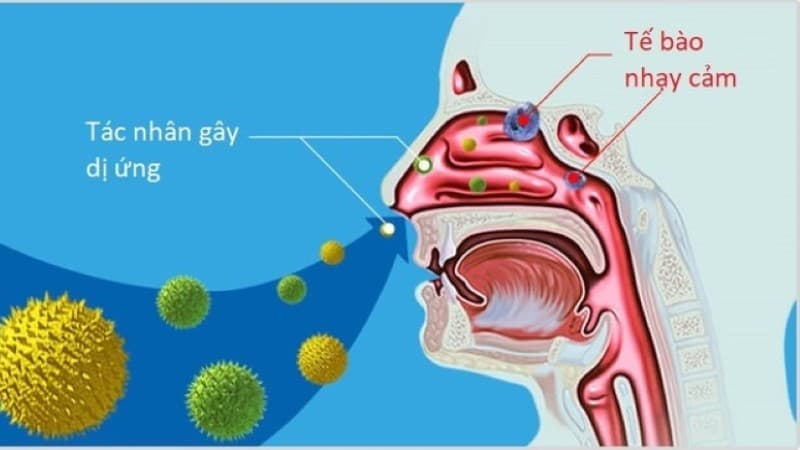 Viêm mũi dị ứng khá phổ biến và là bệnh lý liên quan đến thể dị ứng