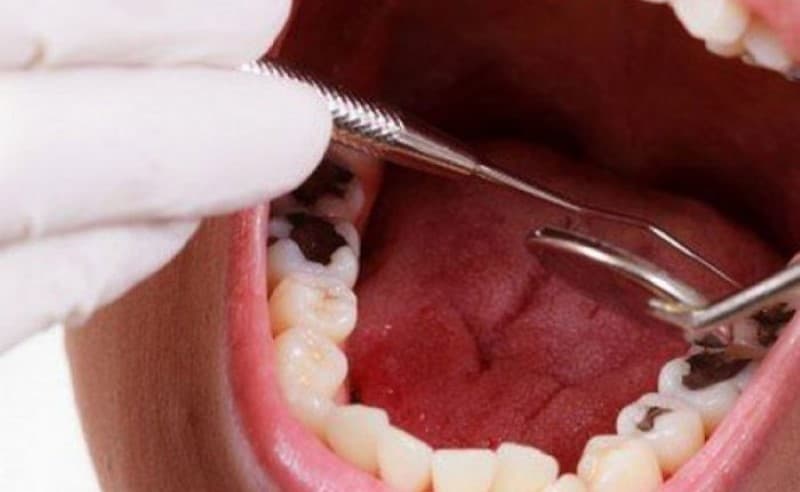 Cách nhổ răng sâu truyền thống