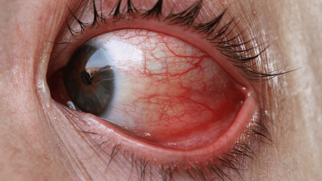 Giải đáp chi tiết: Đau mắt đỏ có lây không?