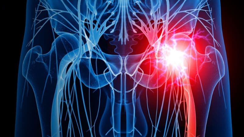 Triệu chứng và sự ảnh hưởng của cơn đau dây thần kinh tọa tại mông