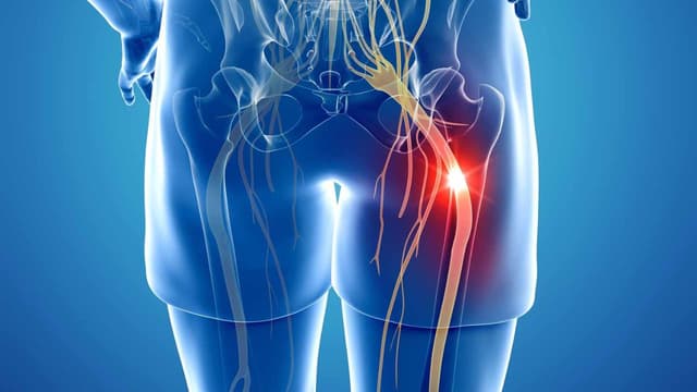 Cơn đau thần kinh tọa: Nguyên nhân xuất hiện, biểu hiện