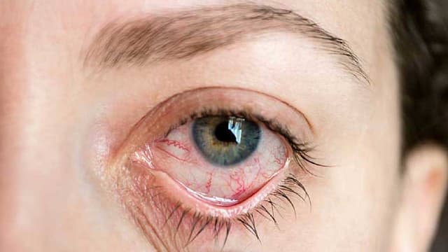 Cách điều trị viêm màng bồ đào và biện pháp phòng tránh