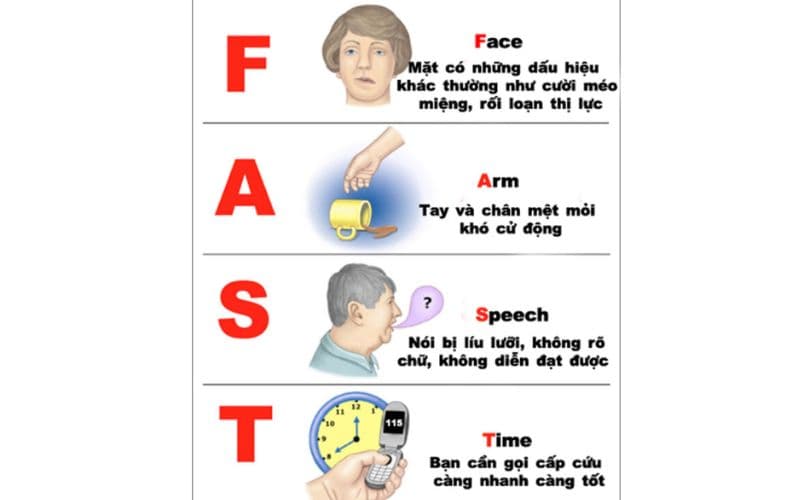 Dấu hiệu cho thấy đột quỵ sắp xảy ra