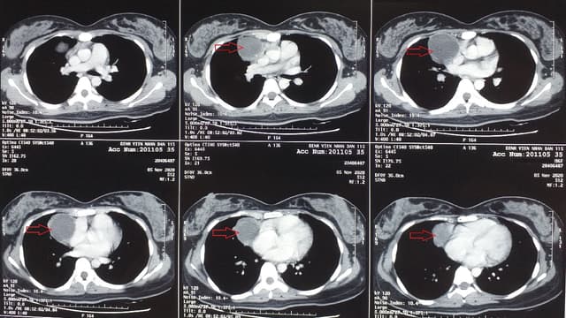 Giải đáp thắc mắc u trung thất là gì