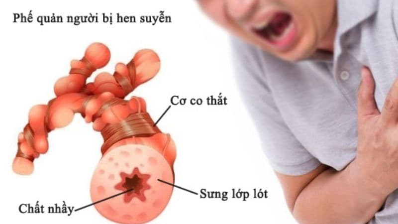 Thuốc giãn phế quản dạng xịt sử dụng cho nguy cơ bệnh nào?