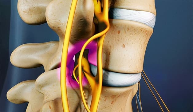 Hẹp lỗ liên hợp đốt sống là bệnh gì 