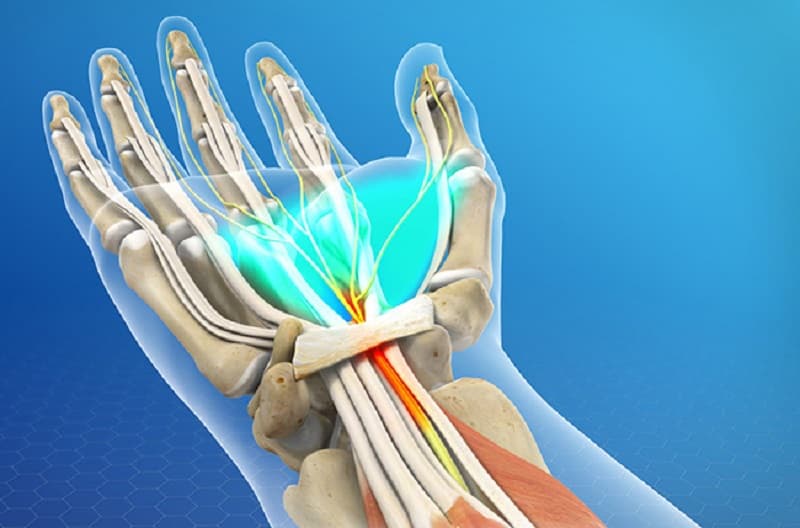 Cơ chế gây ra hội chứng ống cổ tay