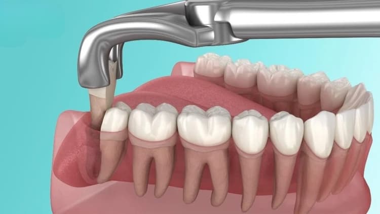 cách để răng khôn mọc thẳng