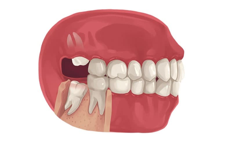 Không nhổ răng khôn mọc lệch