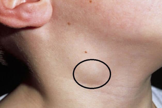 mức độ lây của bệnh lao hạch