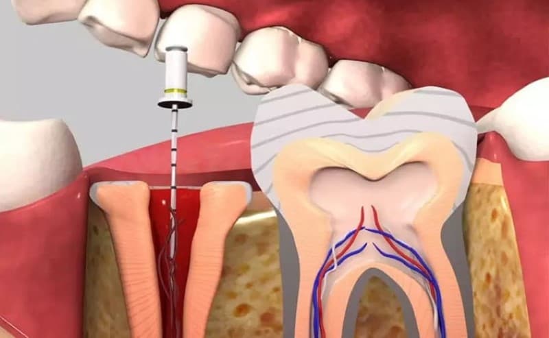 Tìm hiểu lý do bị sâu răng