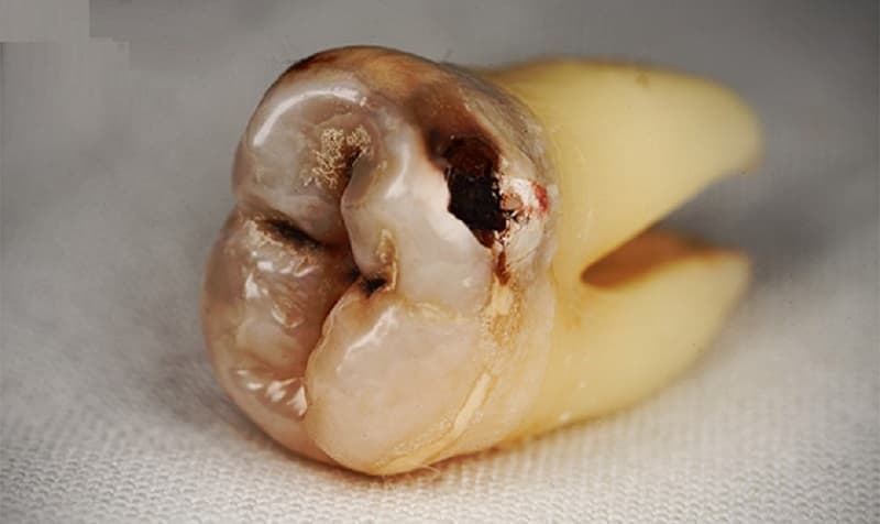 Phương pháp nhổ răng khôn hàm trên bị sâu