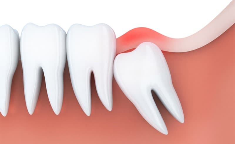 Sự thật nhổ răng khôn làm nhỏ mặt