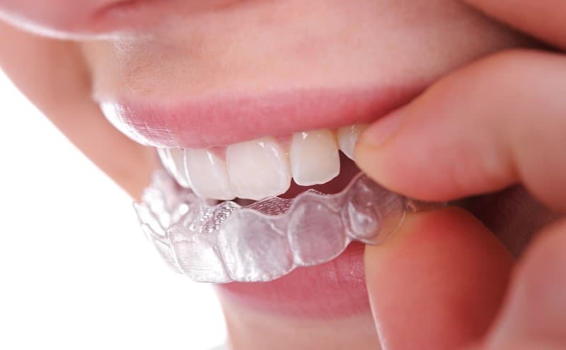 Phương pháp niềng răng 3D Clear