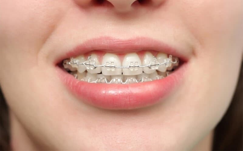 Thực hiện niềng răng hô nhẹ