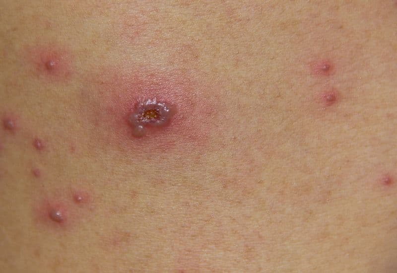 Tổn thương da nhiễm trùng thường đi kèm với tình trạng sưng, đỏ, nóng, đau. Tình trạng này có thể lan ra các vùng da xung quanh tổn thương.