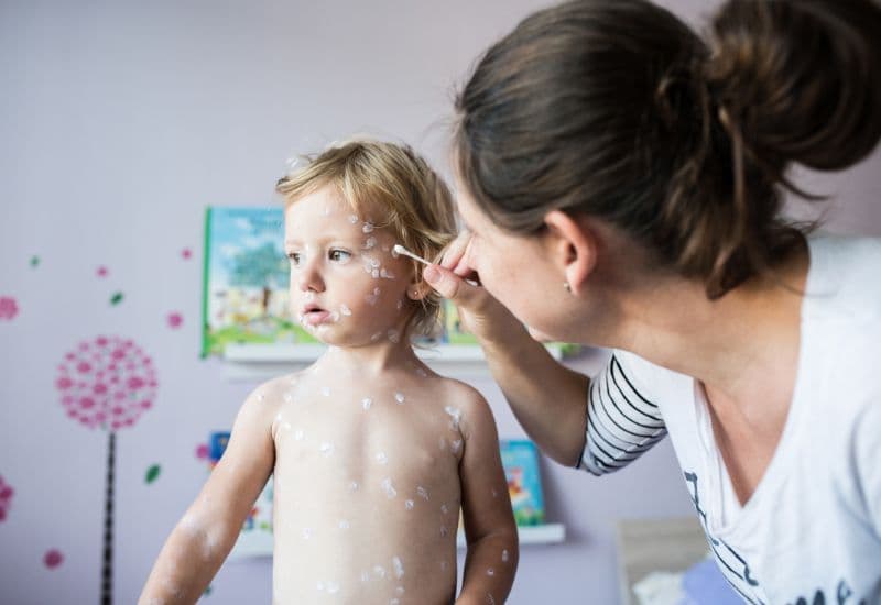 Thuốc bôi nốt thủy đậu bị nhiễm trùng