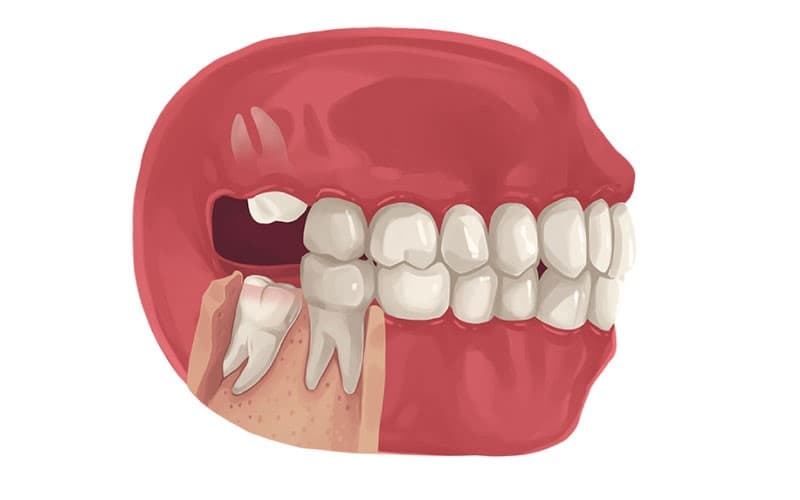 Quy trình nhổ răng số 8