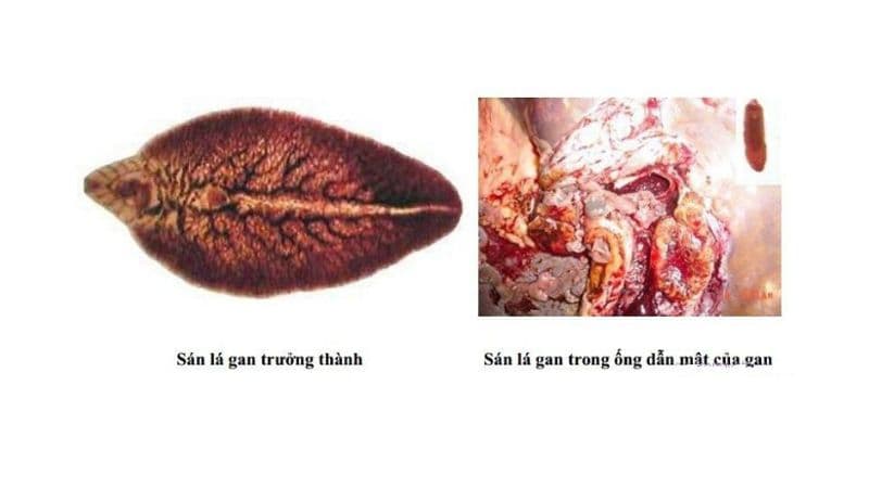 thuốc sán lá gan sử dụng với tình trạng nào?