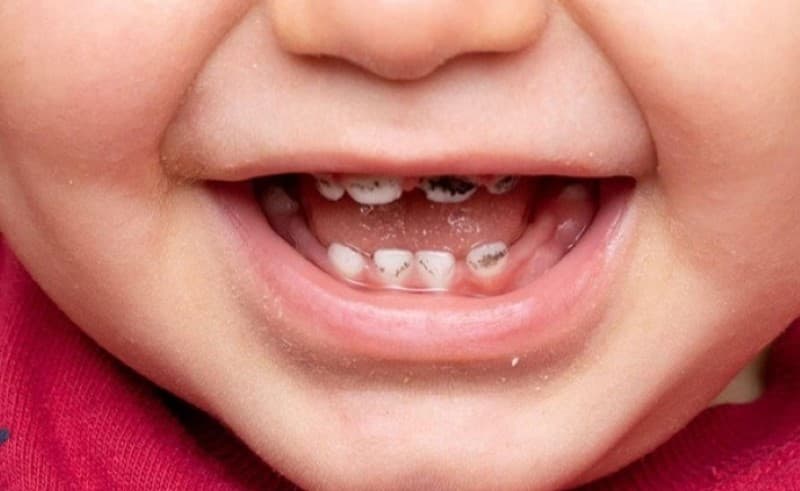 Răng sữa bị sâu