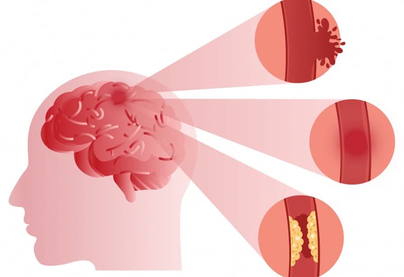 Tai biến mạch não là gì?