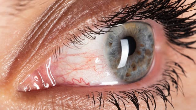 Tăng nhãn áp: Bệnh lý nhãn khoa không thể chữa khỏi