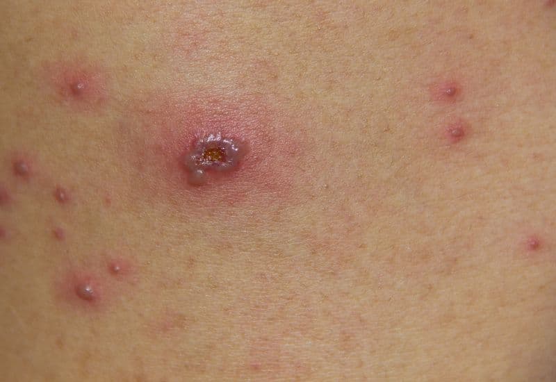 Thủy đậu ở trẻ sơ sinh tiềm ẩn nhiều rủi ro về sức khỏe.