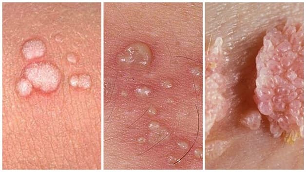 Mụn cóc sinh dục hay sùi mào gà do HPV xuất hiện ở cả nam giới và nữ giới có thể ngăn chặn bằng việc tiêm vacxin HPV