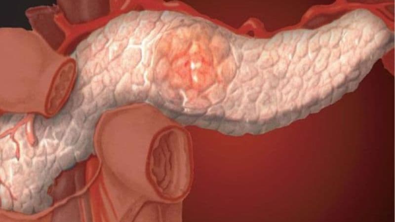 Triệu chứng viêm tụy mạn