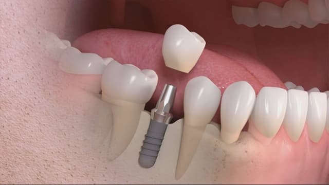 Tìm hiểu về kỹ thuật trồng răng Implant và địa chỉ thực hiện uy tín