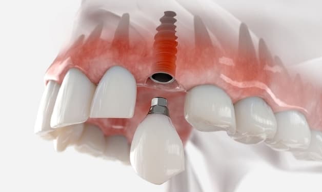 Trồng răng Implant