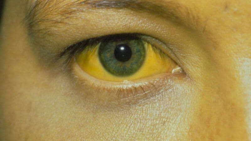 Thuốc cho bệnh nhân gan nhiễm mỡ qua biểu hiện bệnh