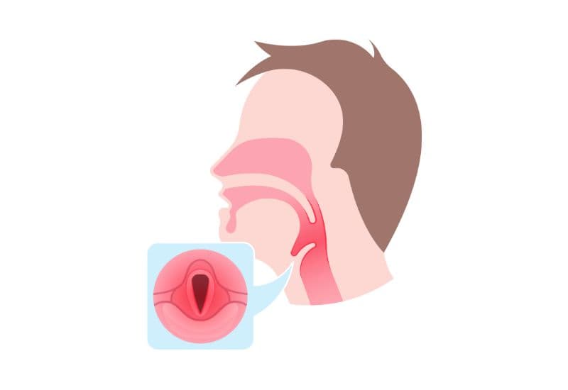 polyp viêm dây thanh quản