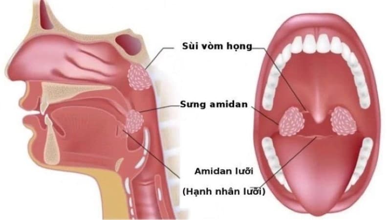 Biểu hiện viêm họng hạt mạn tính