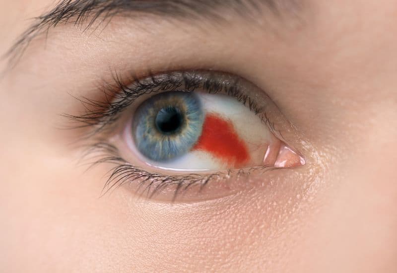 Đau mắt, đỏ mắt là một triệu chứng nhiễm trùng màng bồ đào trước.