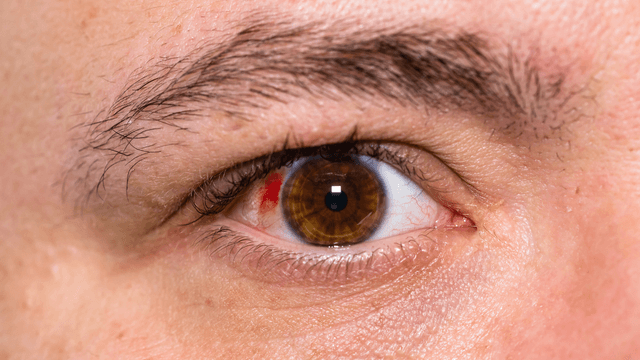 Viêm màng bồ đào trước: Những điều bạn cần biết