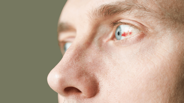 Viêm màng bồ đào: Tiềm ẩn nguy cơ mất thị lực vĩnh viễn