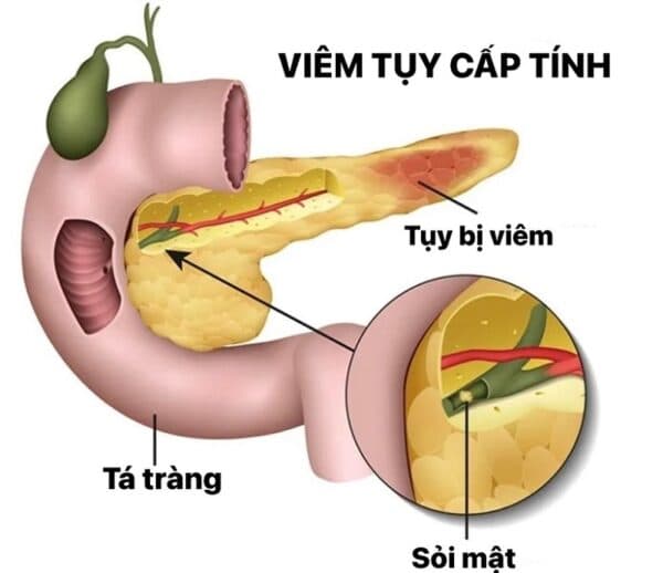 Bệnh viêm tụy cấp