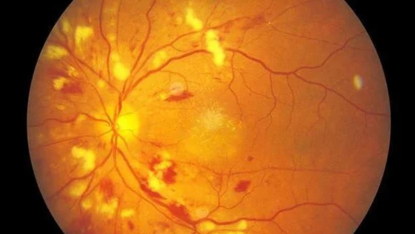 Võng mạc tiểu đường: nguyên nhân, giải pháp và cách phòng tránh