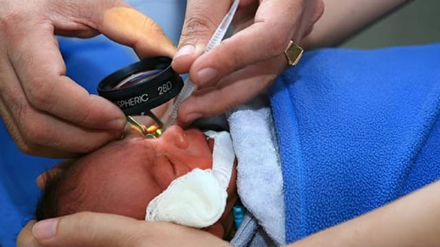 Tìm hiểu về bệnh võng mạc trẻ đẻ non