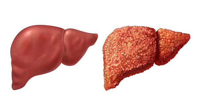 Những lưu ý khi dùng thuốc cho bệnh nhân xơ gan