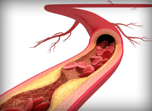Tại sao đột quỵ não là một hệ lụy của xơ vữa động mạch?