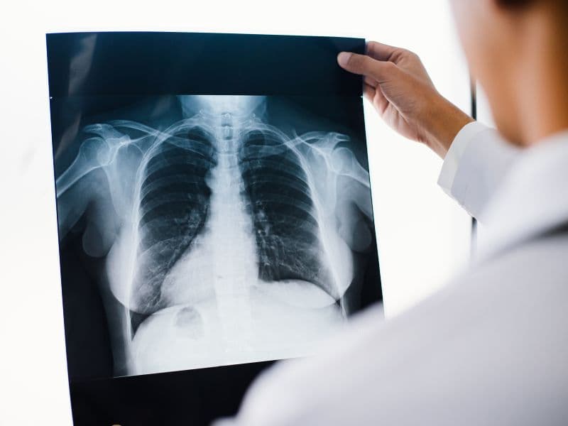 Chụp X-quang phổi là phương pháp chẩn đoán hình ảnh phổ biến