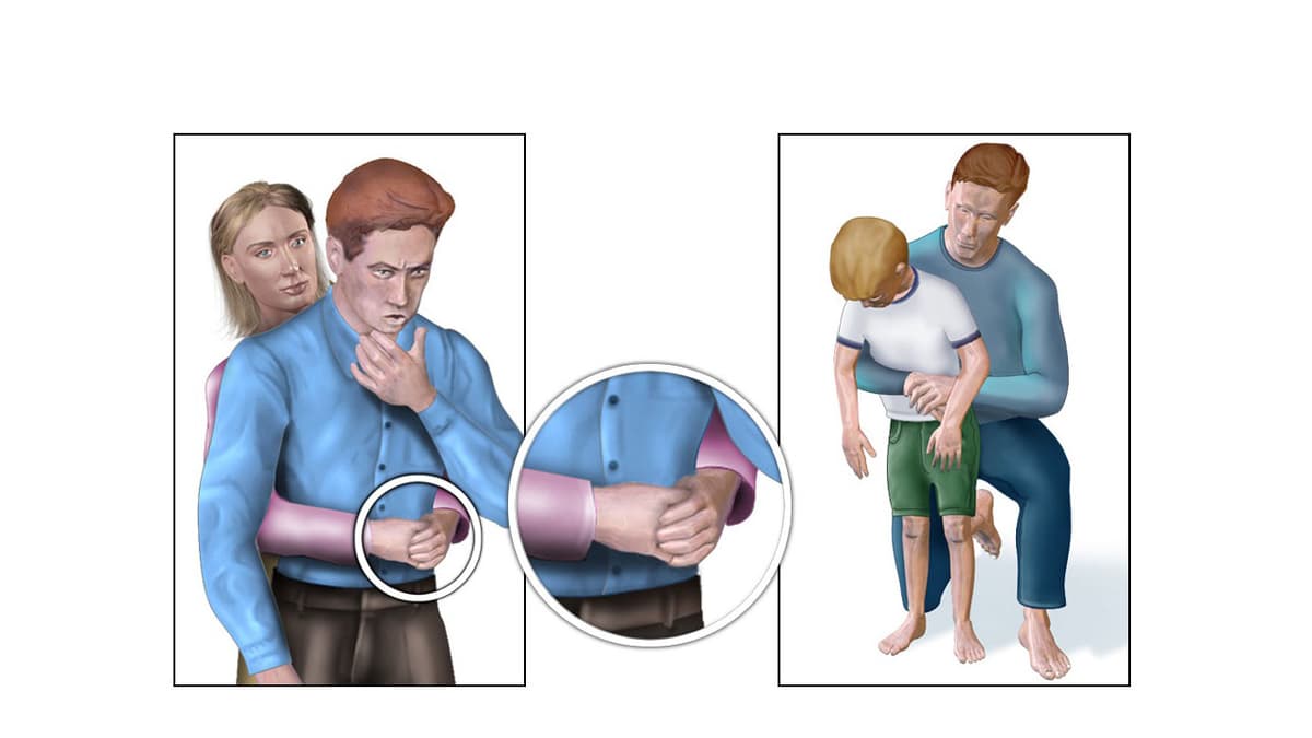 Xử trí hóc dị vật đường thở đúng cách theo từng nhóm đối tượng
