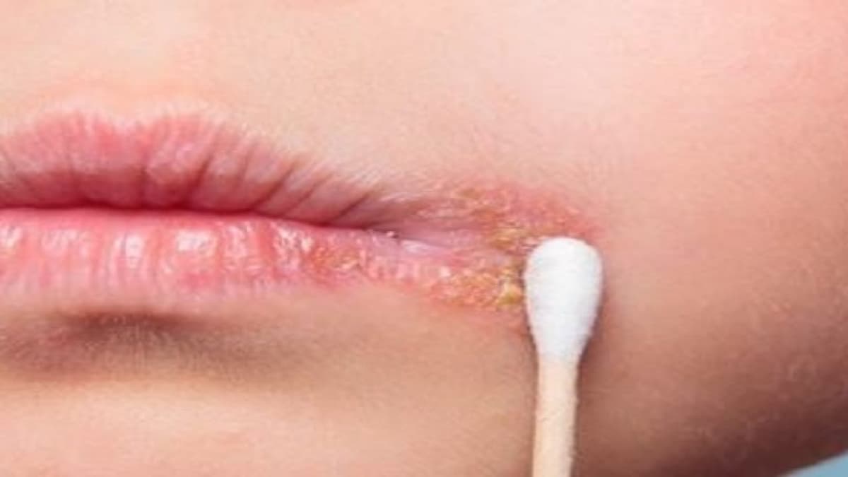 Acyclovir bôi môi: Thông tin và cách sử dụng
