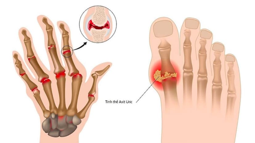 Bệnh gout có thể chữa khỏi không và cách điều trị